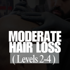 SMP for Moderate Hair Loss (Levels 2-4)