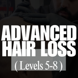 SMP for Advanced Hair Loss (Levels 5-8)